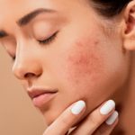 Comment ne plus avoir des boutons d’acné?
